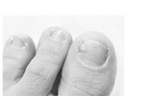 TERBINAFIN-1A Pharma Nagell.g.Nagelpilz 78.22mg/ml, 6.6 ml
